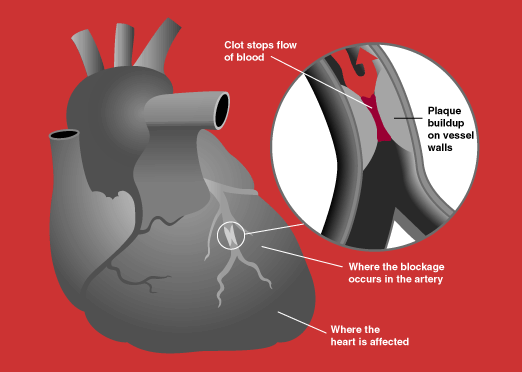 Heart attack diagram